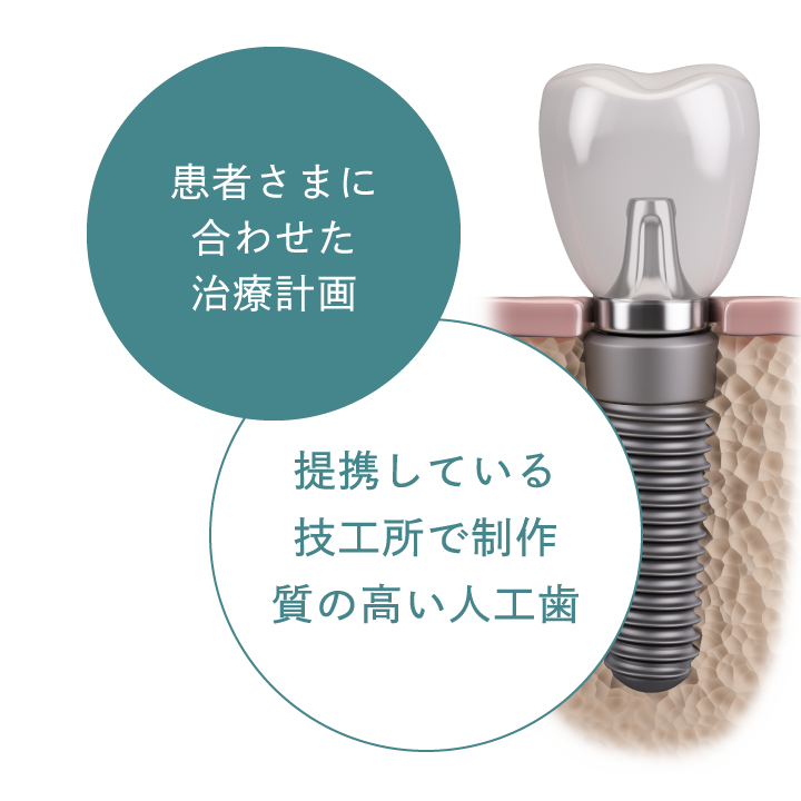 「患者さまに合わせた治療計画」「提携している技工所で制作質の高い人工歯」