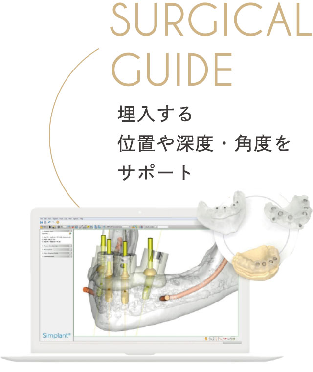 埋入する位置や深度・角度をサポート