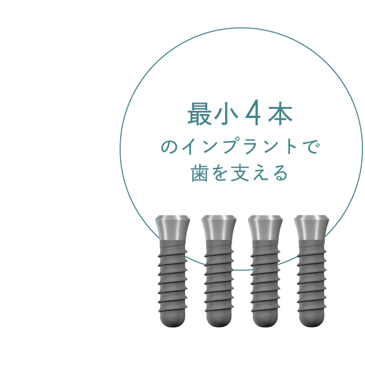 最小4本のインプラントで歯を支える