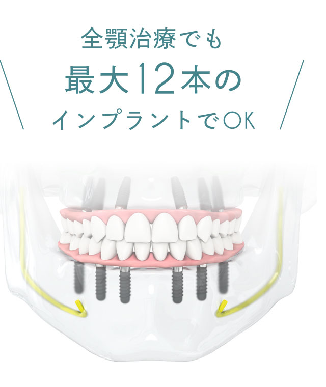 全顎治療でもインプラントでOK