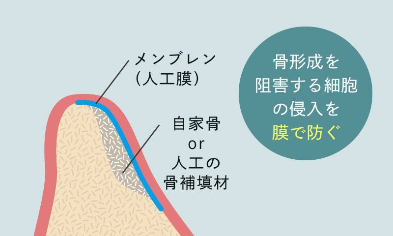 骨形成を阻害する細胞の侵入を膜で防ぐ