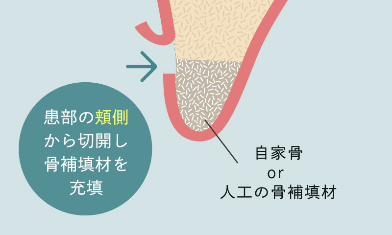 患部の頬側から切開し骨補填材を充填