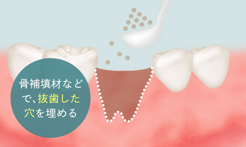 骨補填材などで、抜歯した穴を埋める