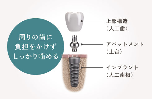 周りの歯に負担をかけずしっかり噛める